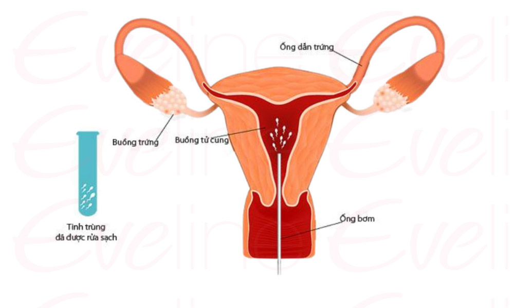 Thực hiện bơm tinh trùng vào tử cung không giúp sàng lọc giới tính