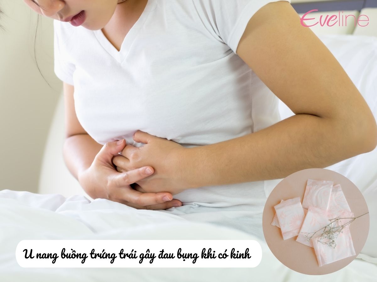 U nang buồng trứng trái gây đau bụng khi đến kỳ kinh nguyệt