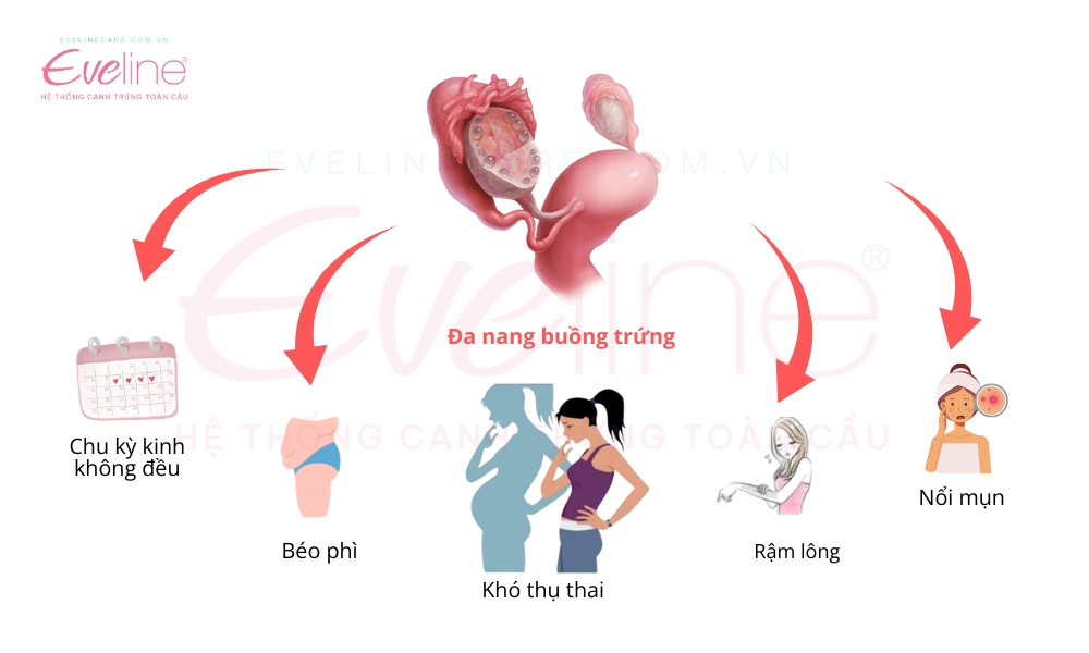 Biểu hiện của người bị đa nang buồng trứng